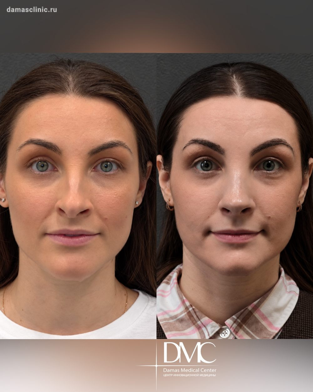 4 недели с момента женской структурной риносептопластики при травме носа в анамнезе. Работа доктора Рагима Агаларовича Садыхова