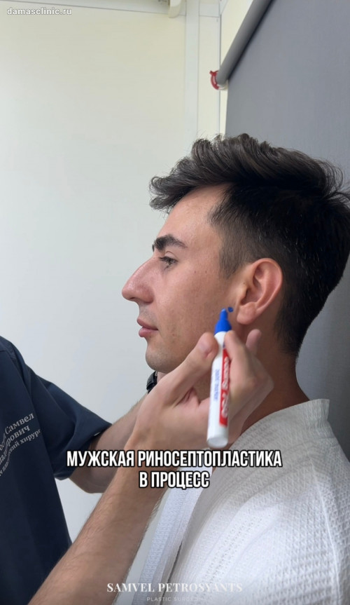 Как проводится мужская риносептопластика. Процесс с комментариями