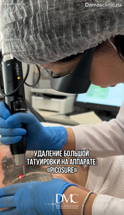 Удаление большой татуировки на аппарате «Picosure» под наркозом (в медицинском сне)