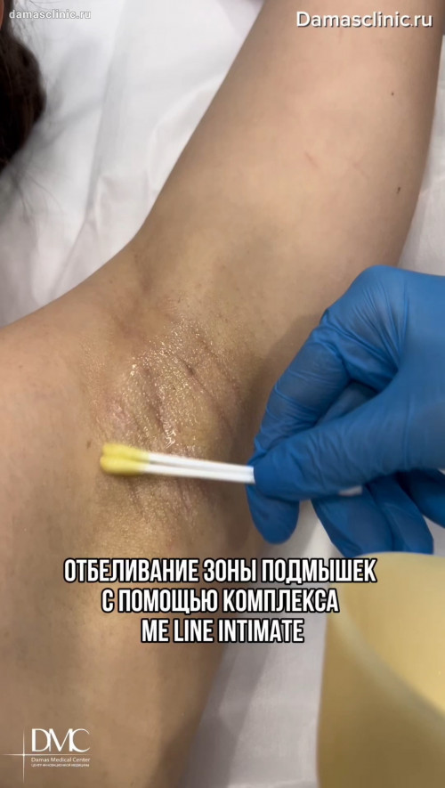 Отбеливание зоны подмышек с помощью комплекса ME Line INTIMATE. Преимущества процедуры