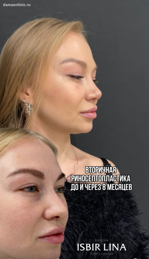 Повторная ринопластика в отзыве пациентки с видео