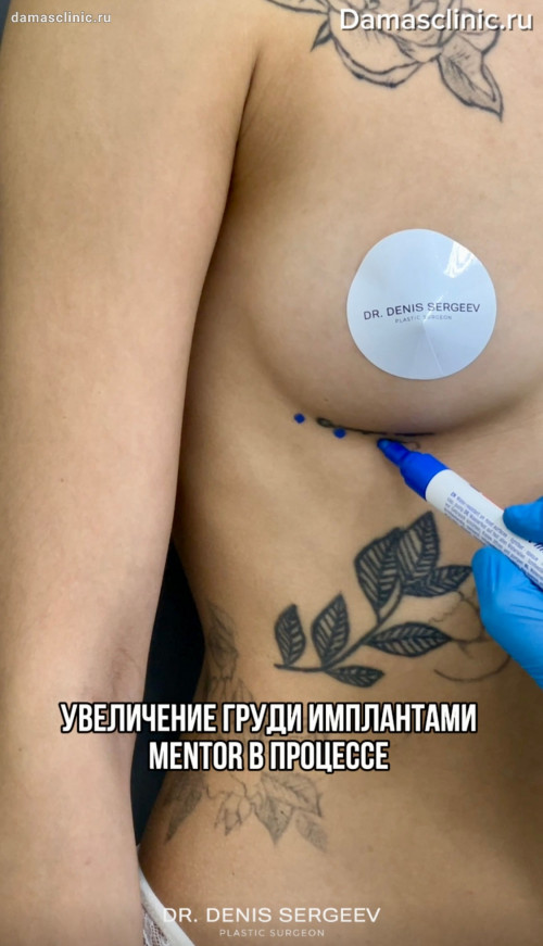 Увеличение груди имплантами MENTOR в процессе, до и сразу после с фото- и видео результатами