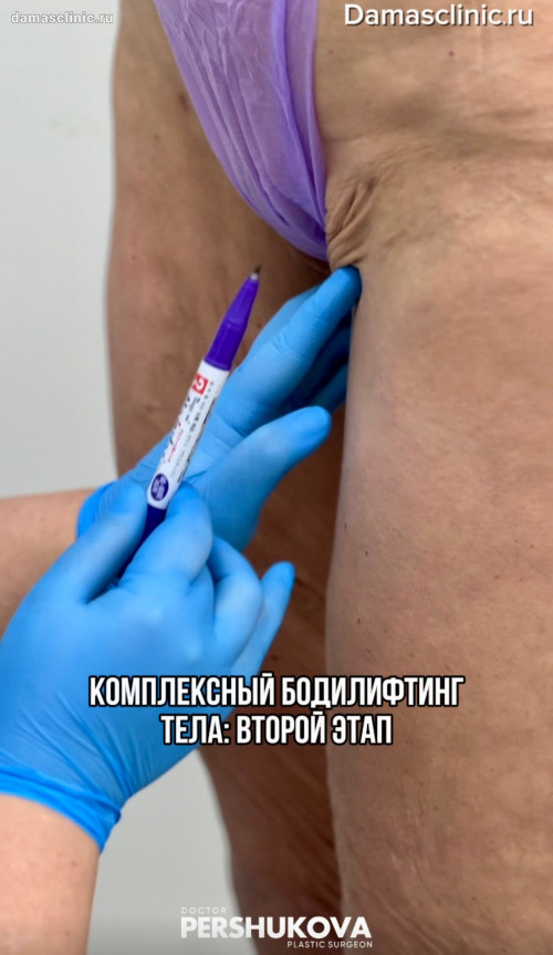 Комплексный бодилифтинг тела - второй этап: до и сразу после с фото результата