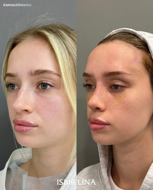 Женская риносептопластика + височный лифтинг одномоментно с фото результатами