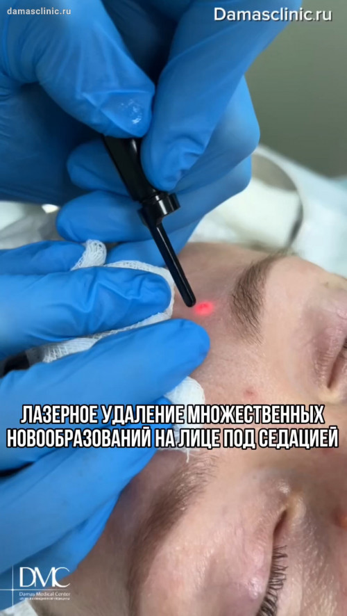 Лазерное удаление множественных новообразований на лице под седацией - в медикаментозном сне
