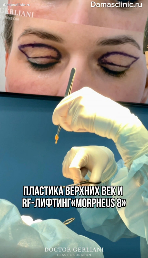 Можно ли совмещать пластику лица и аппаратные процедуры одномоментно. Видео