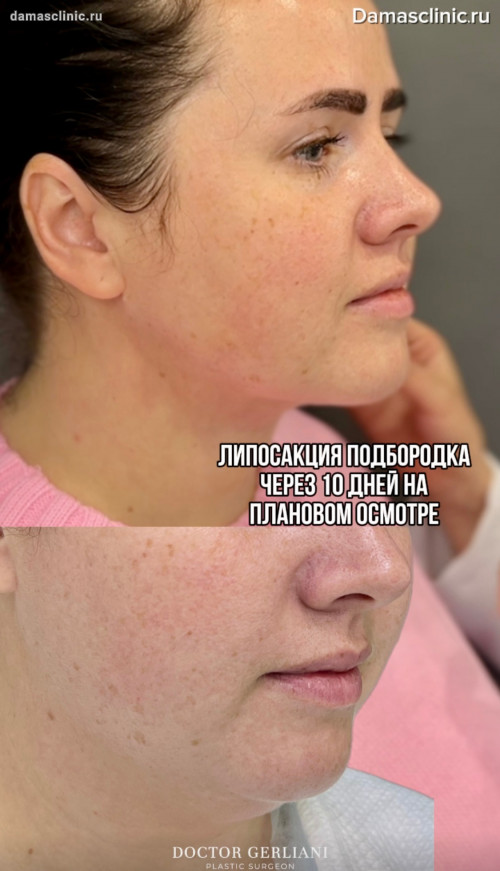 Как выглядит подбородок на 10-е сутки после липосакции на аппарате Vaser: видео- и фото-результат