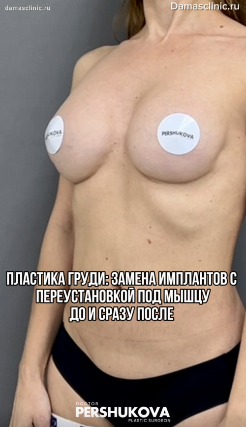 Пластика груди: замена имплантов с переустановкой под железу (после сторонних специалистов) в видео-результате
