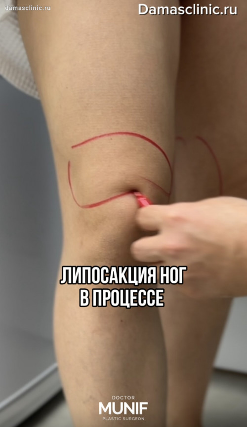 Ультразвуковая липосакция ног – коленей и голеней - в процессе на аппарате Vaser. Видео с комментариями