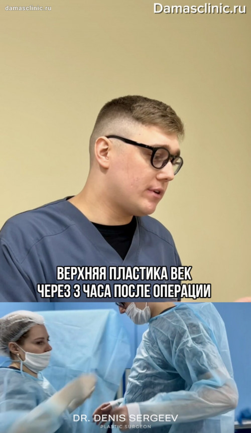 Как себя чувствует пациент через пару часов после пластики век. Видео–отзыв