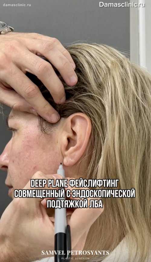 DEEP PLANE фейслифтинг, совмещенный с эндоскопической подтяжкой лба в видео с комментариями в процессе