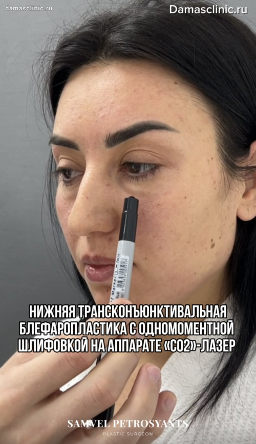 Совмещение пластики и косметологии под наркозом. Нижняя трансконъюнктивальная блефаропластика с одномоментной шлифовкой на «CO2»-лазере