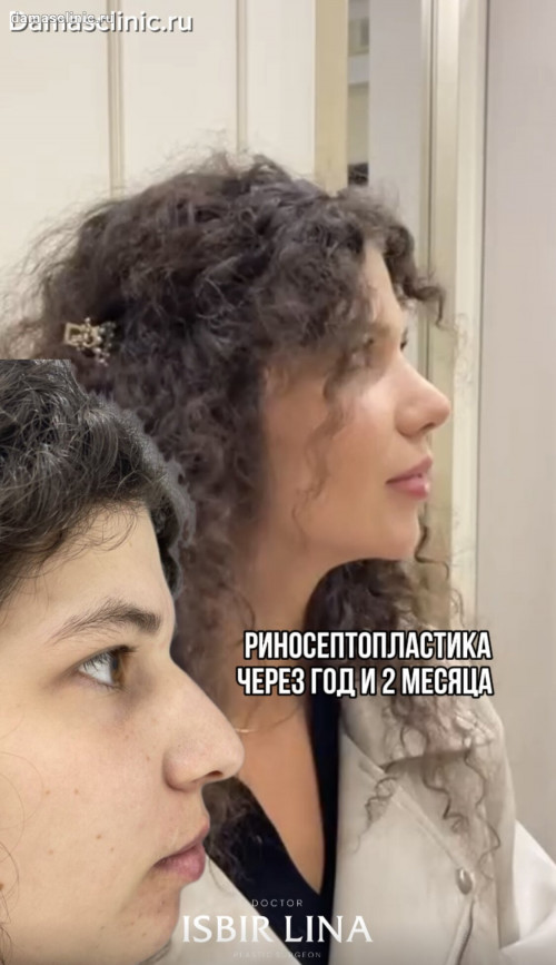 Женская риносептопластика с толстой кожей: до и через год на плановом осмотре. Видео результата