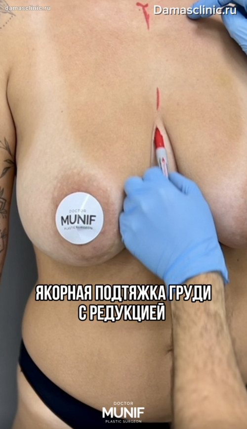 Как проводится уменьшение груди: якорная подтяжка с редукцией. Видео процесса и результата