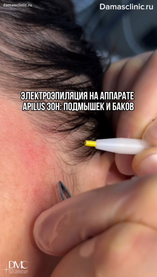 Электроэпиляция на аппарате APILUS CLEO зон подмышек и баков в процессе с комментариями