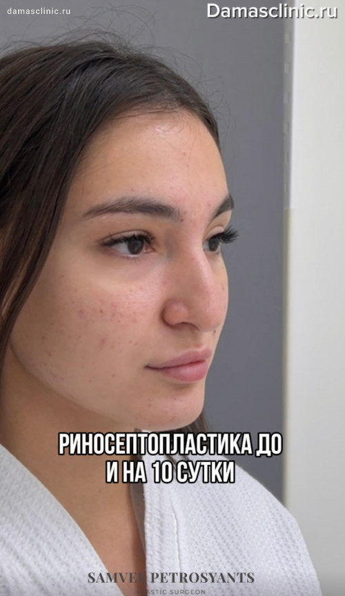 Как выглядит нос с толстой кожей на 10 сутки после риносептопластики