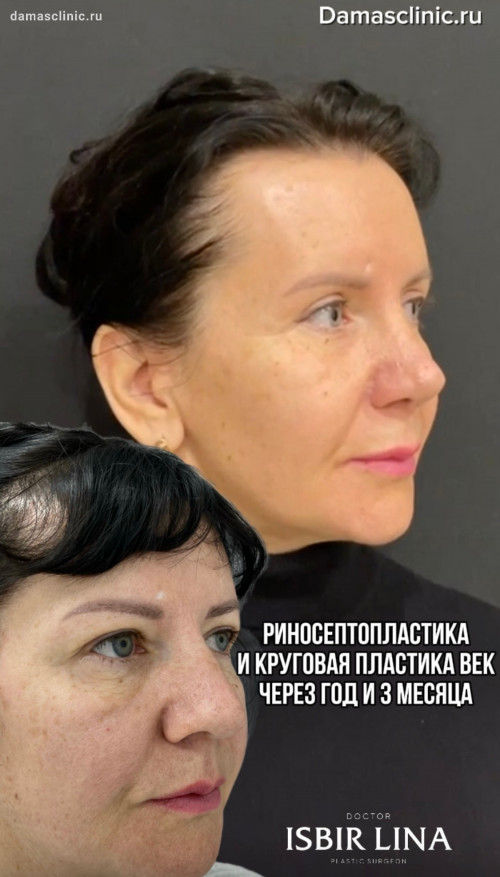Риносептопластика и круговая пластика век через год и 3 месяца в видео-отзыве от пациента