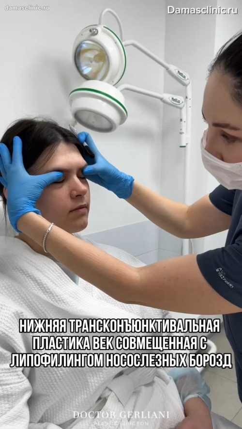 Нижняя трансконъюнктивальная пластика век, совмещенная с липофилингом носослезных борозд в процессе с комментариями
