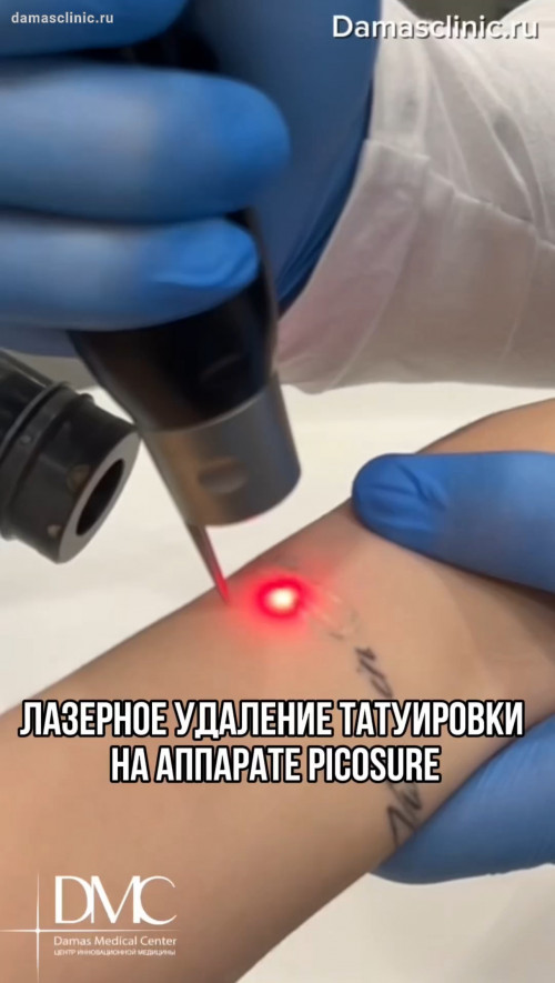 Лазерное удаление татуировки на аппарате PICOSURE в процессе. Фото результатов
