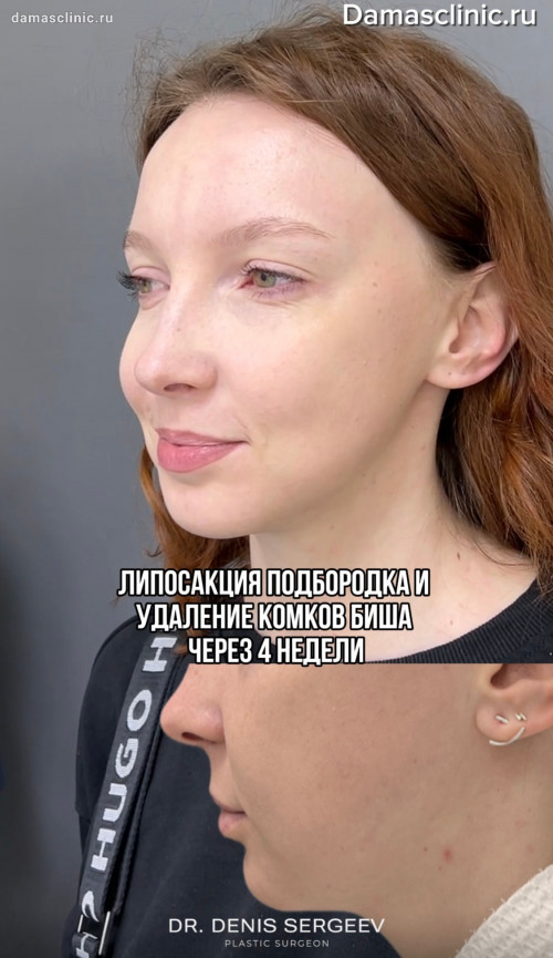 Липосакция подбородка и удаление комков Биша через 4 недели с видео-результатом