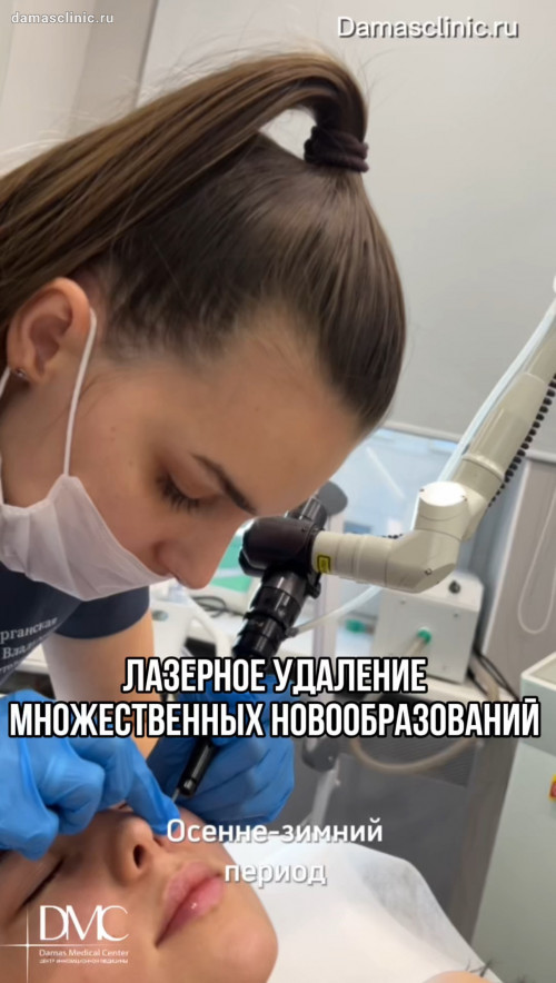 Лазерное удаление множественных новообразований в процессе