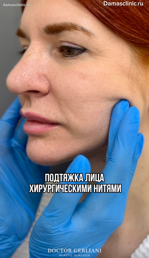 Лифтинг лица хирургическими нитями под седацией с видео-процессом