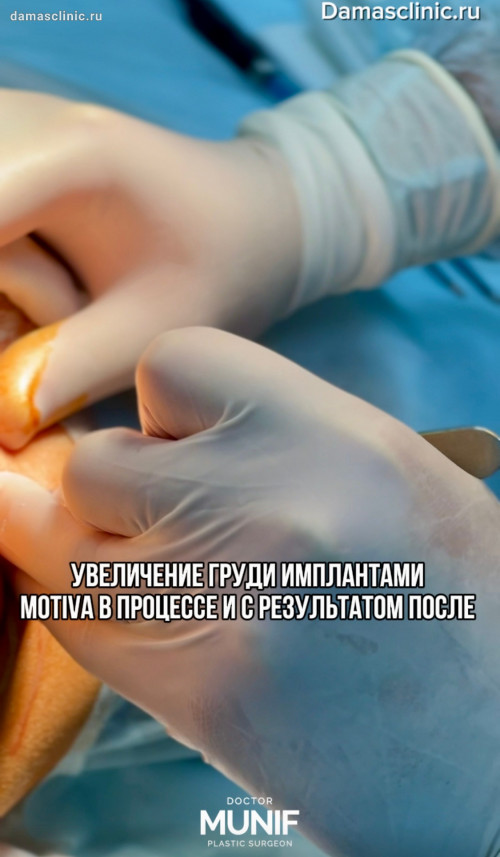 Увеличение груди имплантами MOTIVA в процессе и с результатом сразу после