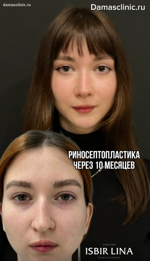 10 месяцев с момента женской риносептопластики с фото- и видео-результатами