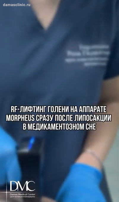 RF-лифтинг голеней на аппарате Morpheus сразу после липосакции в медикаментозном сне. Видео процесса с комментариями