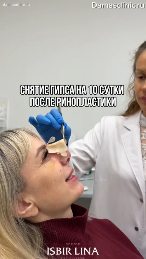Процесс снятия гипса после ринопластики в видео с комментариями
