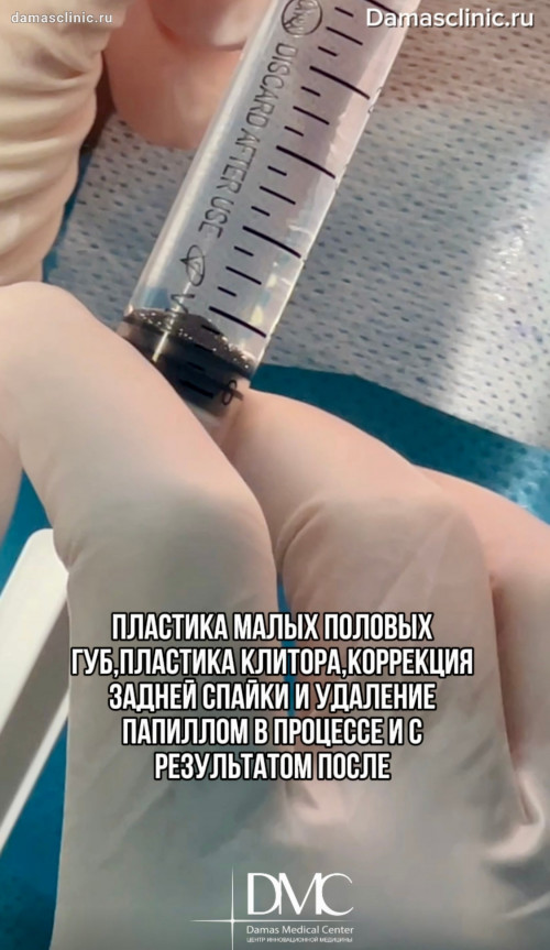 Пластика малых половых губ, пластика клитора, коррекция задней спайки и удаление папиллом в процессе и с результатом после