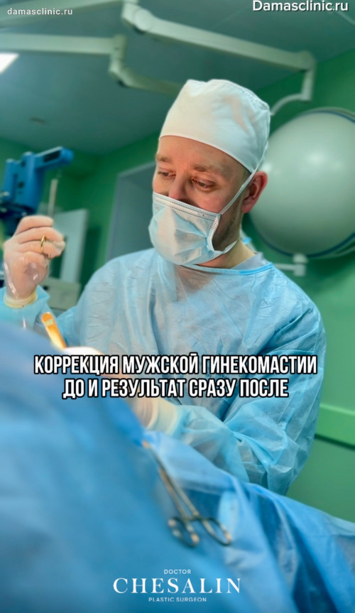 Коррекция мужской гинекомастии в процессе и с результатом сразу после. Фото и видео