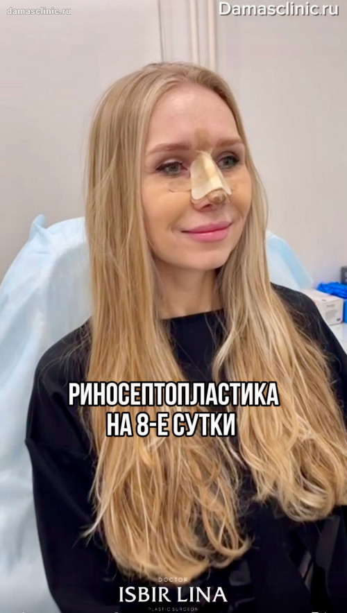 Как себя чувствует пациент на 7-е сутки после ринопластики. Осмотр и видео отзыв