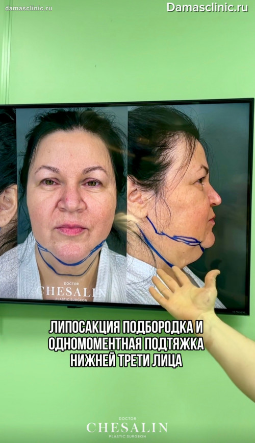 Липосакция подбородка и одномоментная подтяжка нижней трети лица в процессе и с комментариями