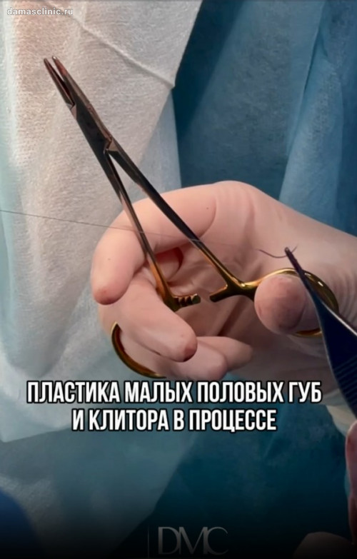 Лабиопластика, пластика клитора с коррекцией задней спайки