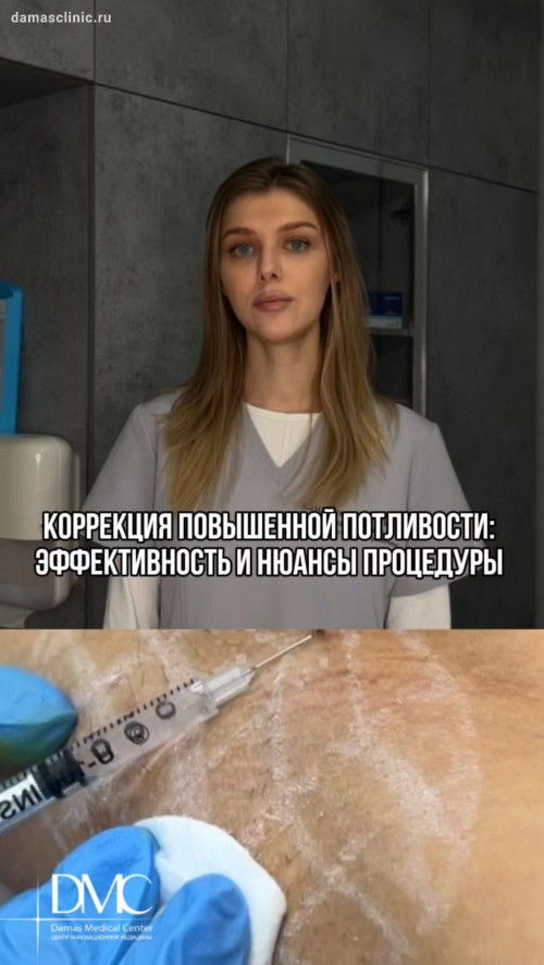 Коррекция повышенной потливости: эффективность и нюансы процедуры с видео-процессом