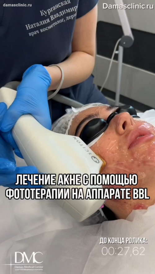 Лечение акне с помощью фототерапии на аппарате BBL. Фото результатов