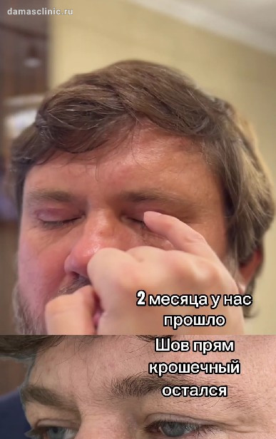 Мужская круговая пластика век через 2 месяца на плановом осмотре с видео-результатом