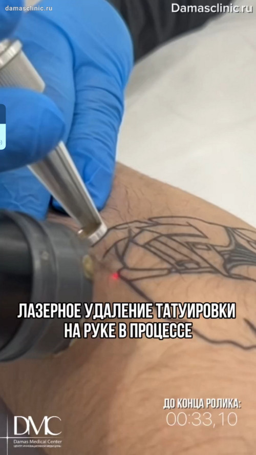Лазерное удаление татуировки на руке в процессе и с фото-результатами