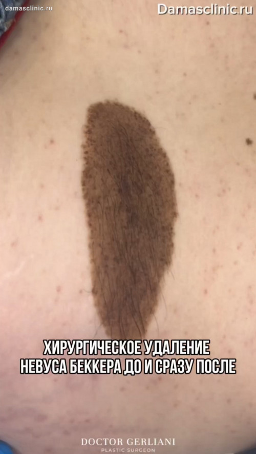 Хирургическое удаление невуса Беккера: результат до и сразу после