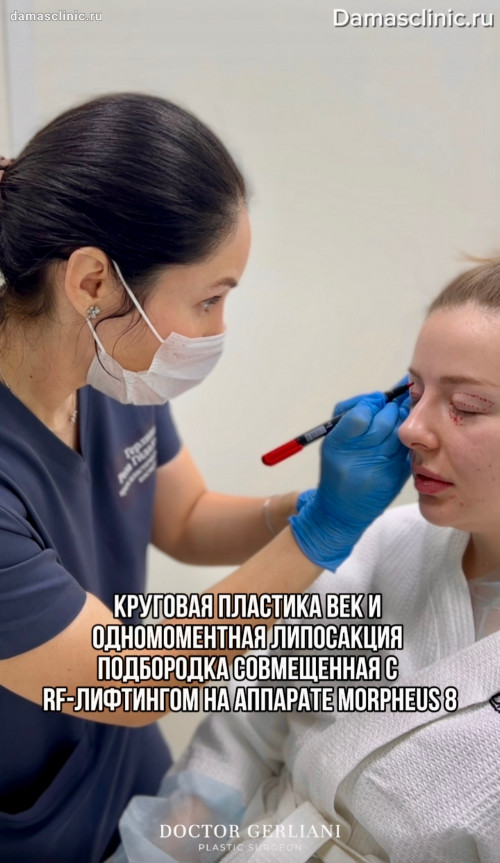 Круговая пластики век и одномоментная липосакция подбородка, совмещенная с RF-лифтингом на аппарате MORPHEUS 8 в процессе