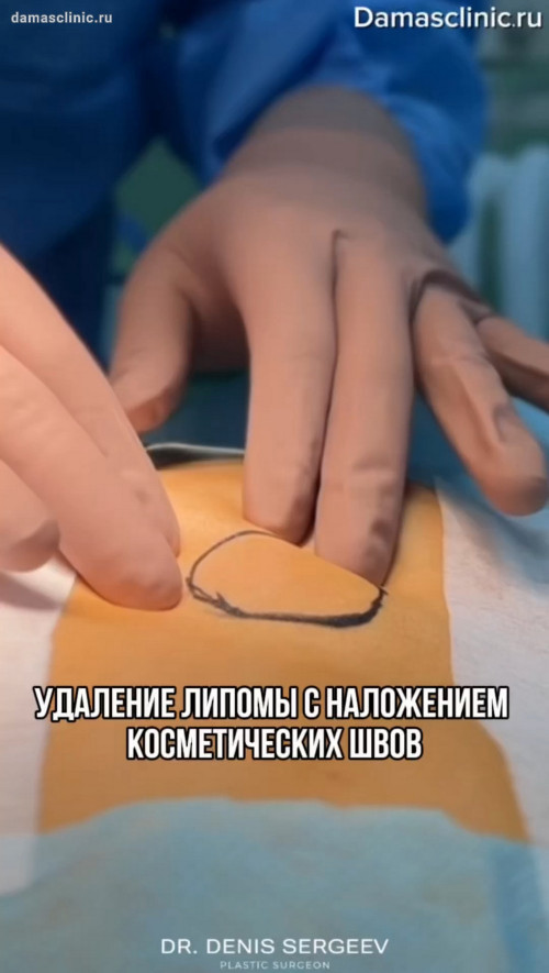 Удаление липомы с наложением косметических швов в процессе и с комментариями доктора