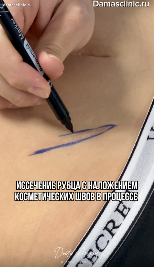 Иссечение рубца с наложением косметических швов в процессе с фото и видео