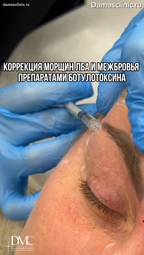 Коррекция морщин лба и межбровья препаратами ботулотоксина с фото-результатами