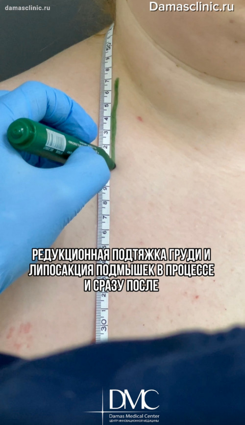 Редукционная подтяжка груди и липосакция подмышек в процессе и фото результатов сразу после