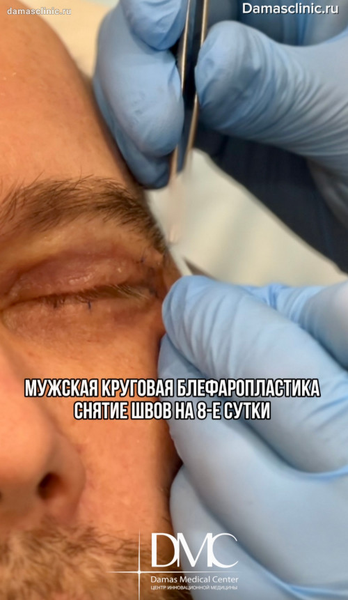 Мужская круговая блефаропластика: снятие швов на 8-е сутки. Период реабилитации