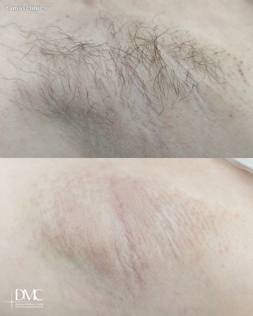 Электроэпиляция на аппарате APILUS / АПИЛУС зоны подмышек: фото до и сразу после процедуры