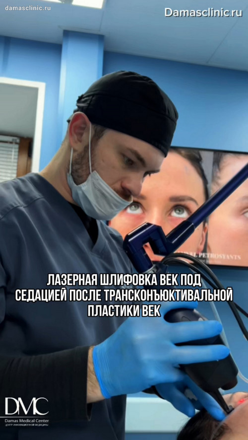 Лазерная шлифовка век под седацией после трансконъюнктивальной пластики век в процессе