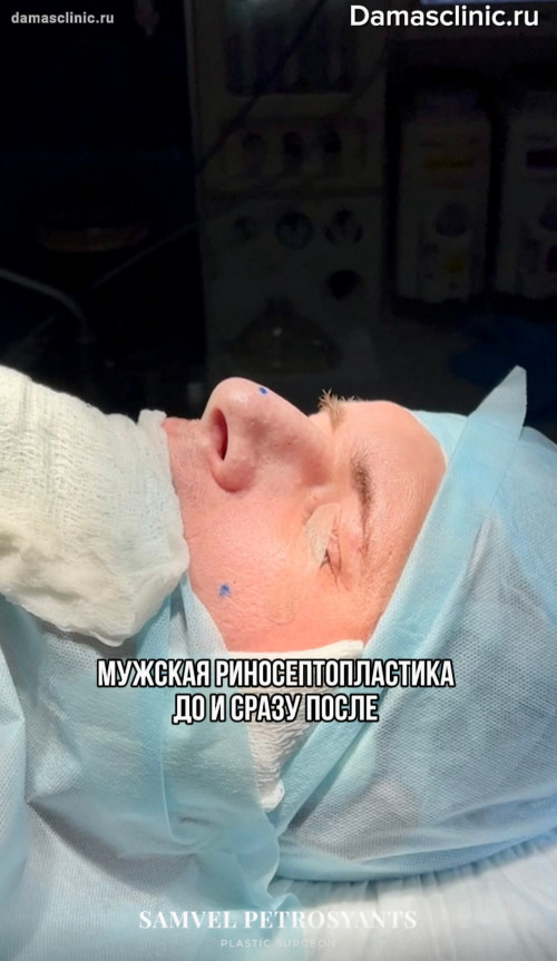 Мужская структурная риносептопластика в процессе и с видео-результатом сразу после