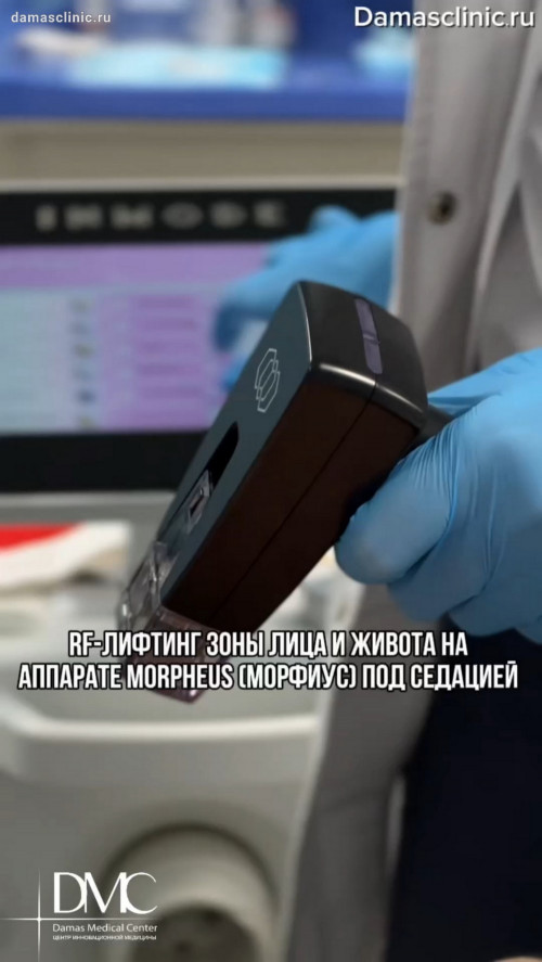 RF-лифтинг зоны лица и живота на аппарате MORPHEUS (МОРФИУС) под седацией: видео процесса с комментариями